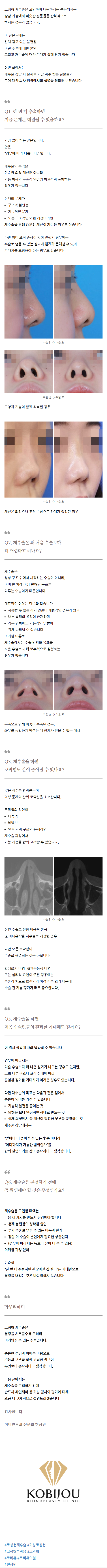 코끝재수술 vqcmx