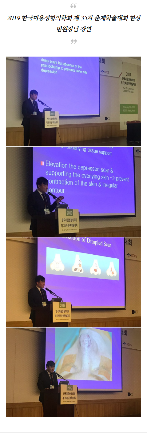 비염수술코성형 slnji