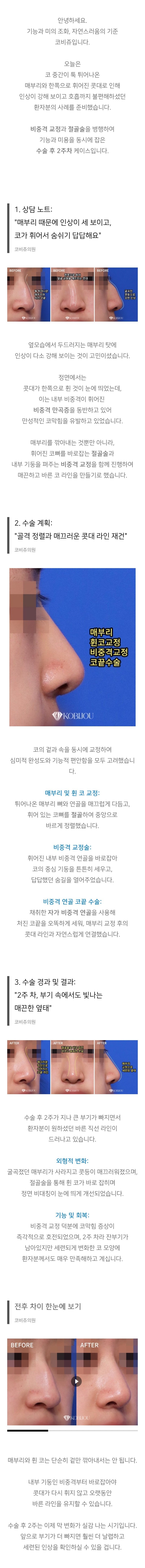 신논현코재수술